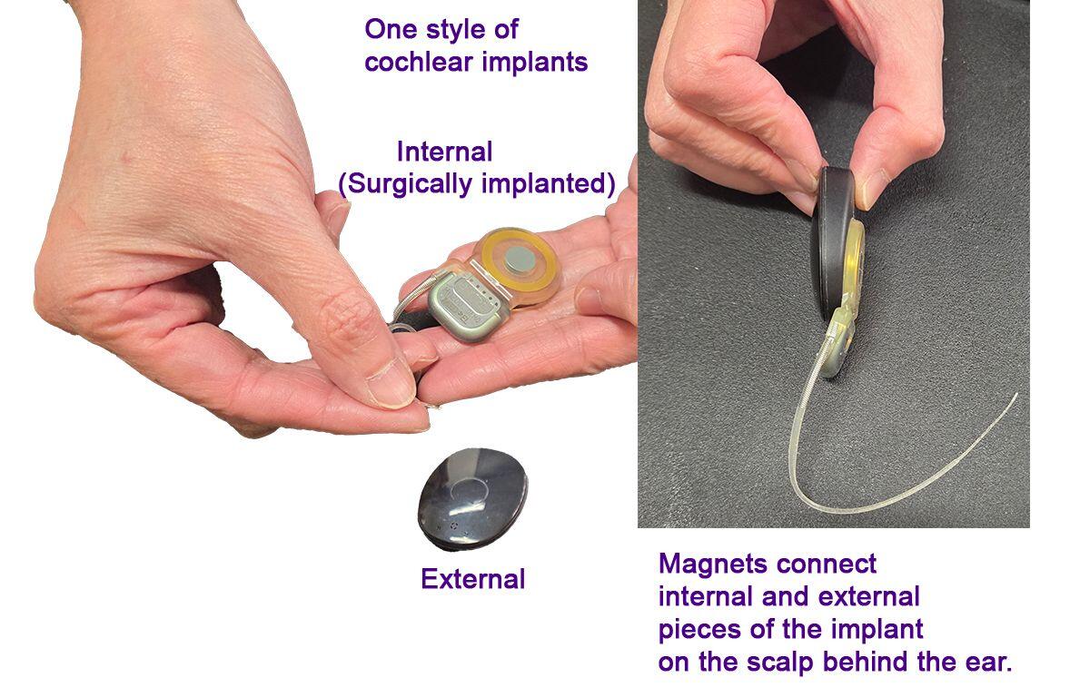 cochlear implants