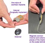 cochlear implants