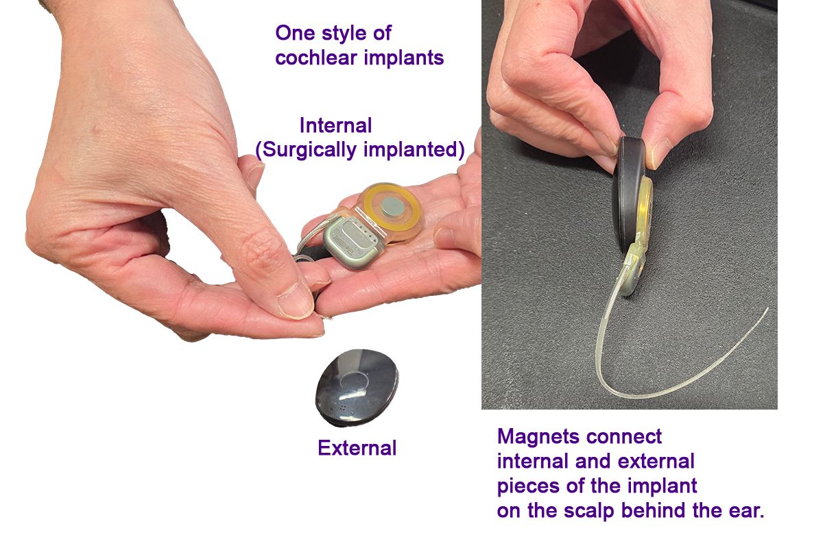 cochlear implants